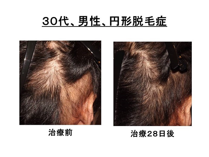 円形脱毛症　病院""
